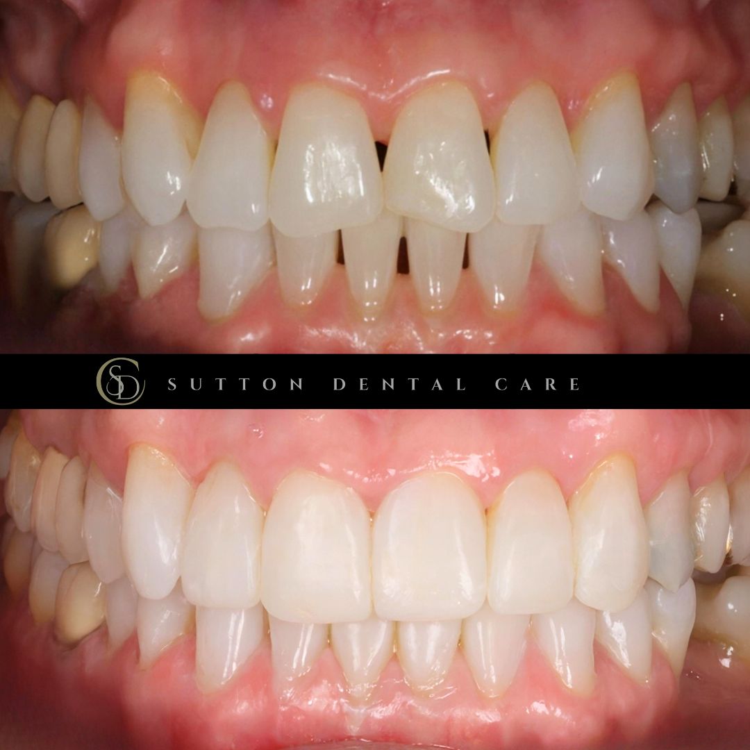 Composite Bonding - Before & After