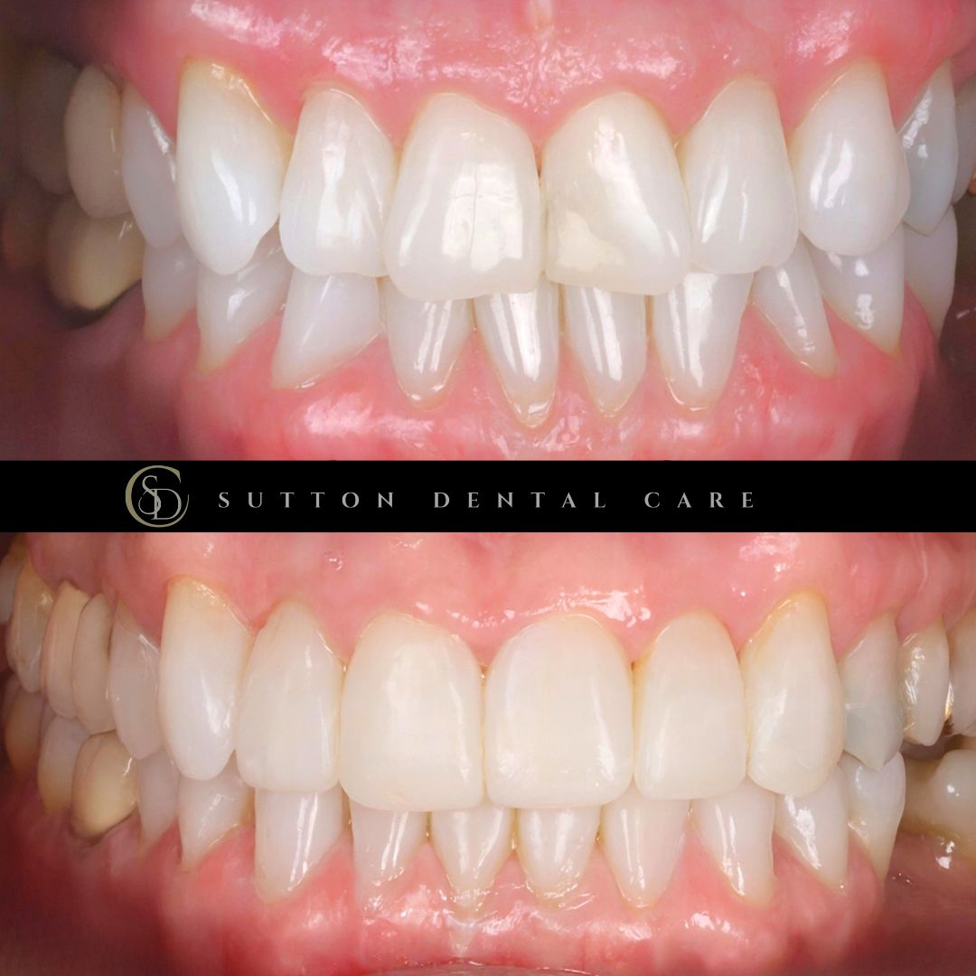 Aligners & Composite Bonding - Before & After
