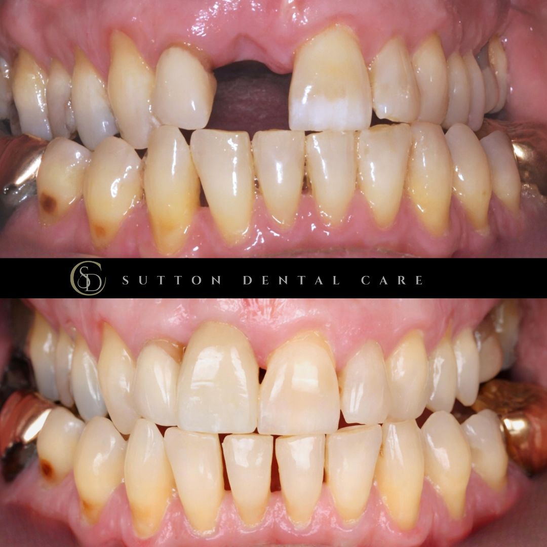 Dental Implant - Before & After