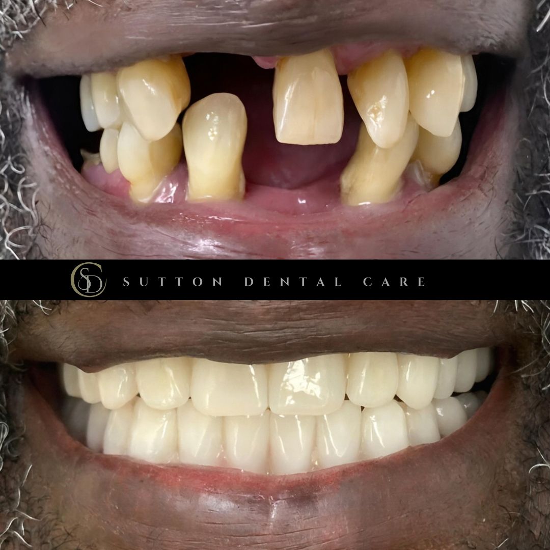 Dentures - Before & After