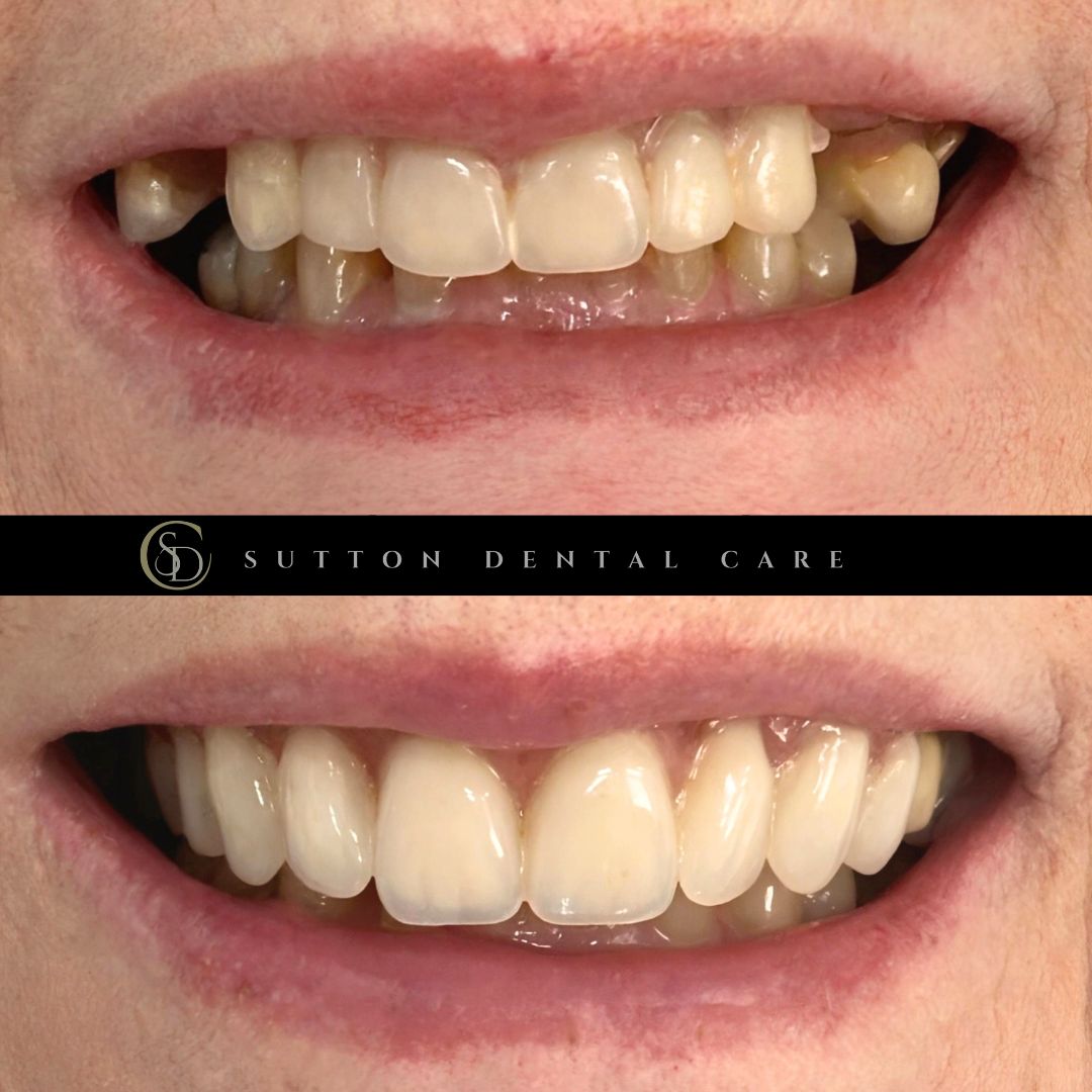 Dentures - Before & After
