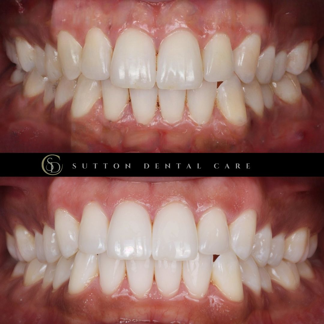 Whitening - Before & After