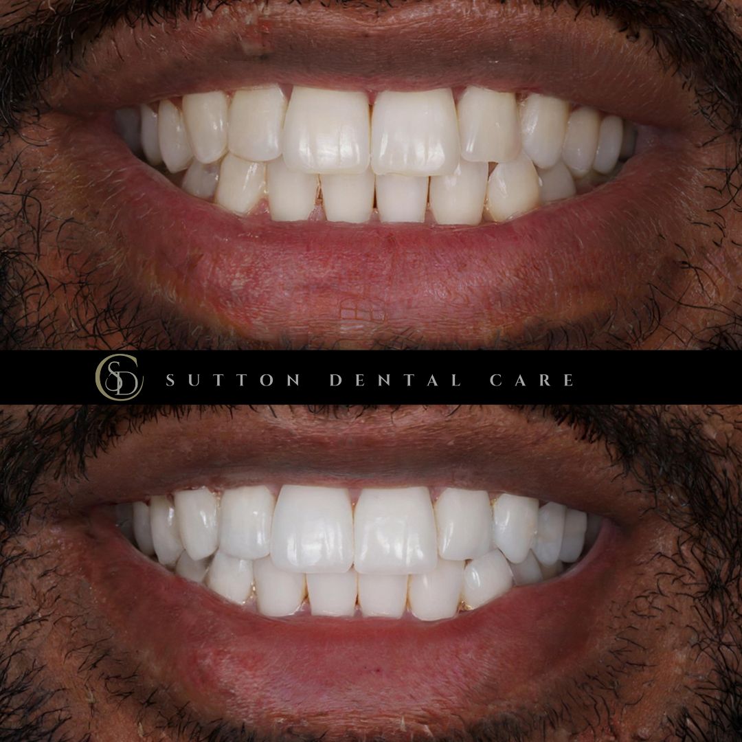 Whitening - Before & After