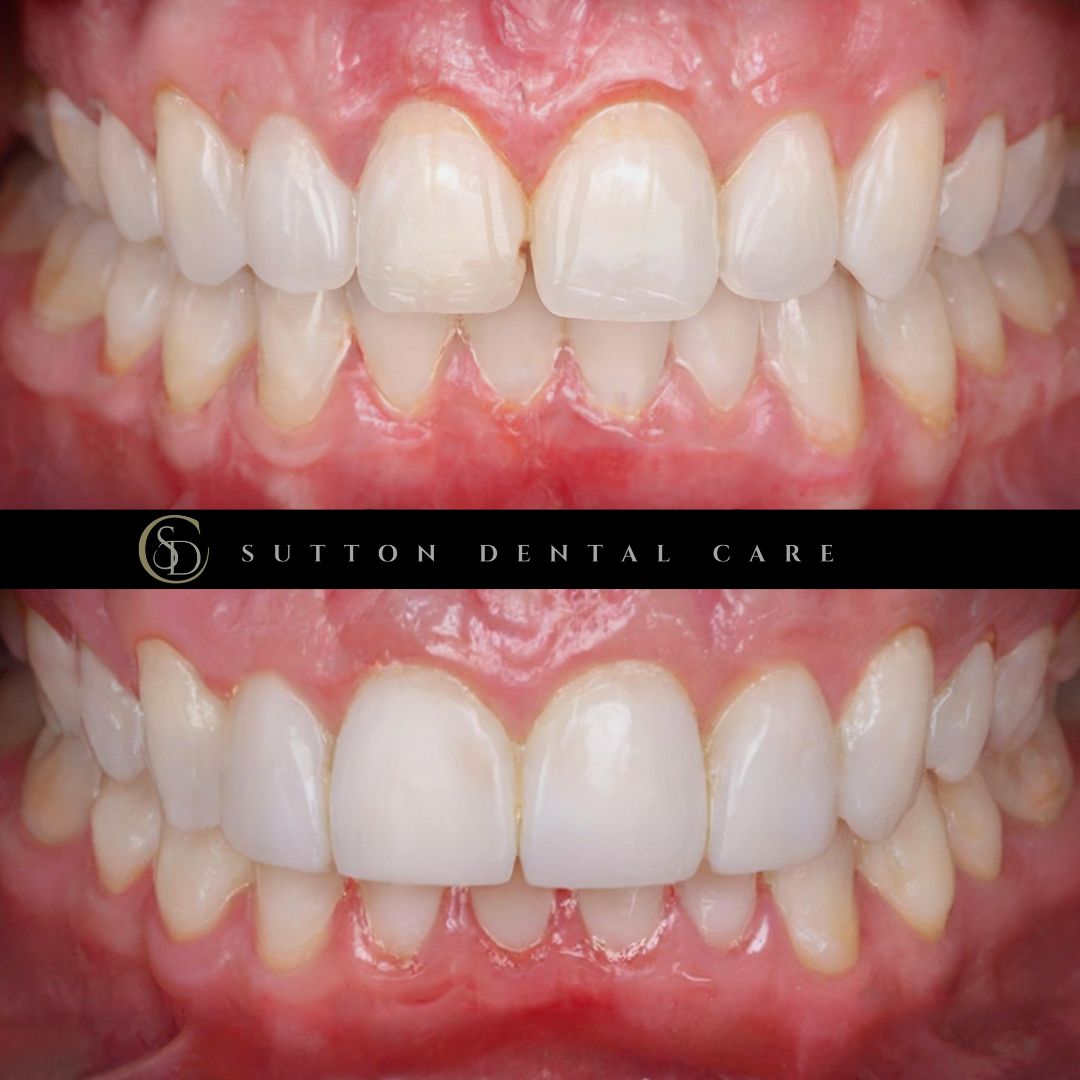 Whitening & Composite Bonding - Before & After