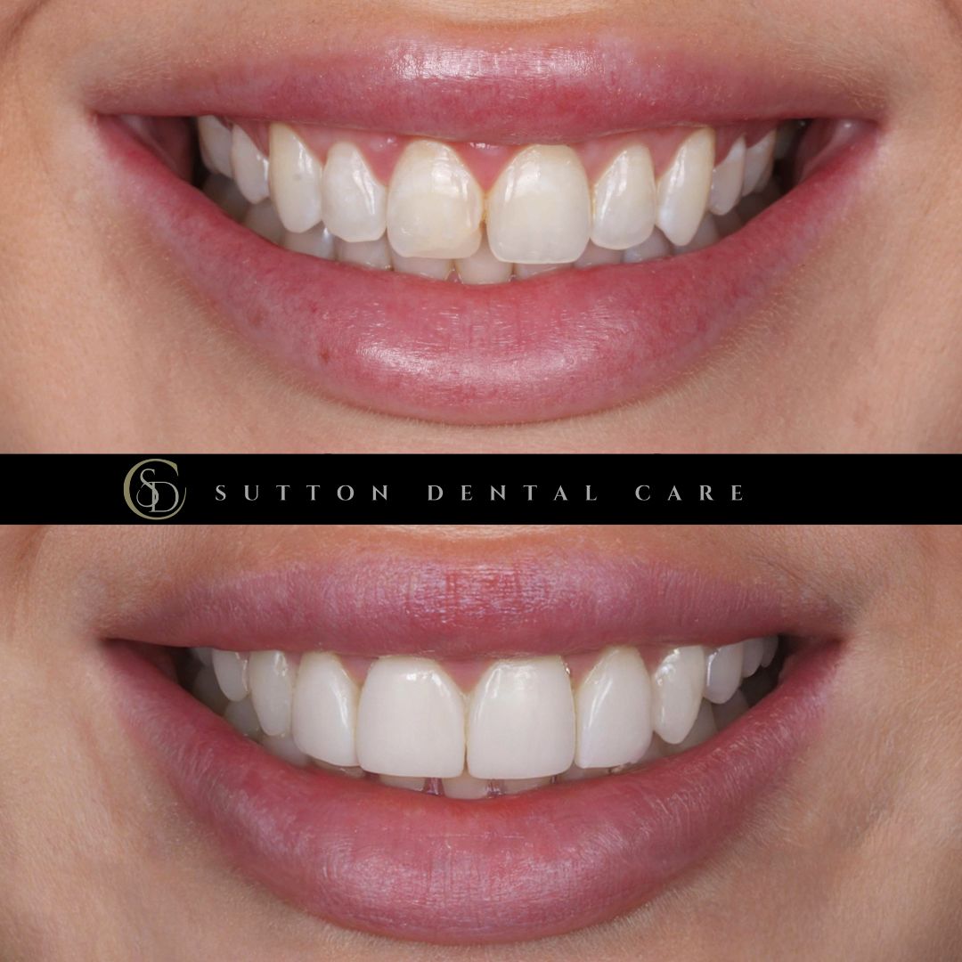 Whitening & Composite Bonding - Before & After