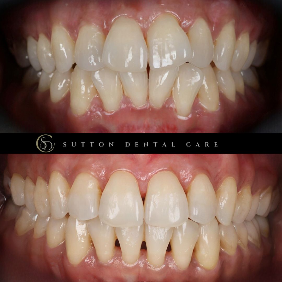 Clear Aligners - Before & After