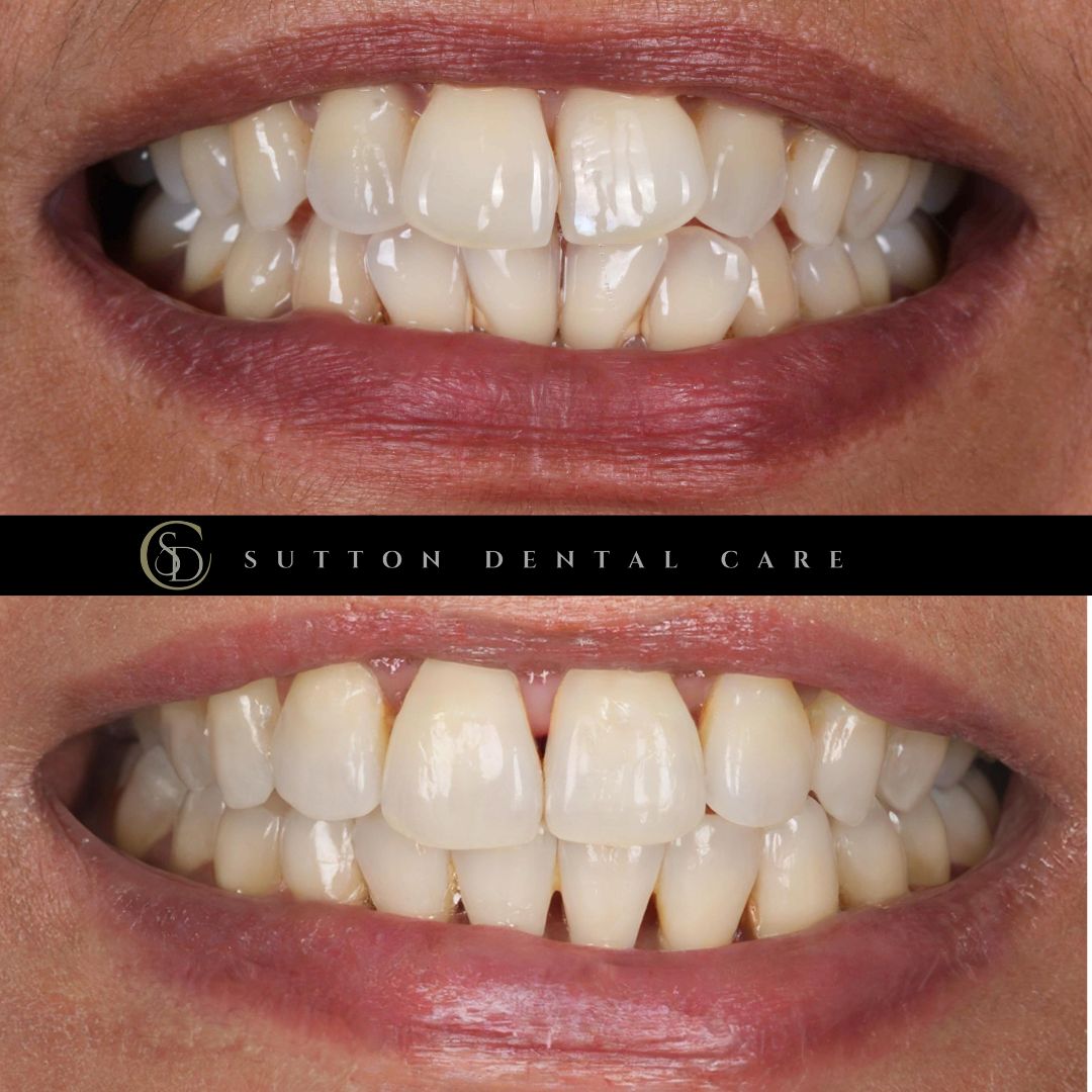 Clear Aligners - Before & After