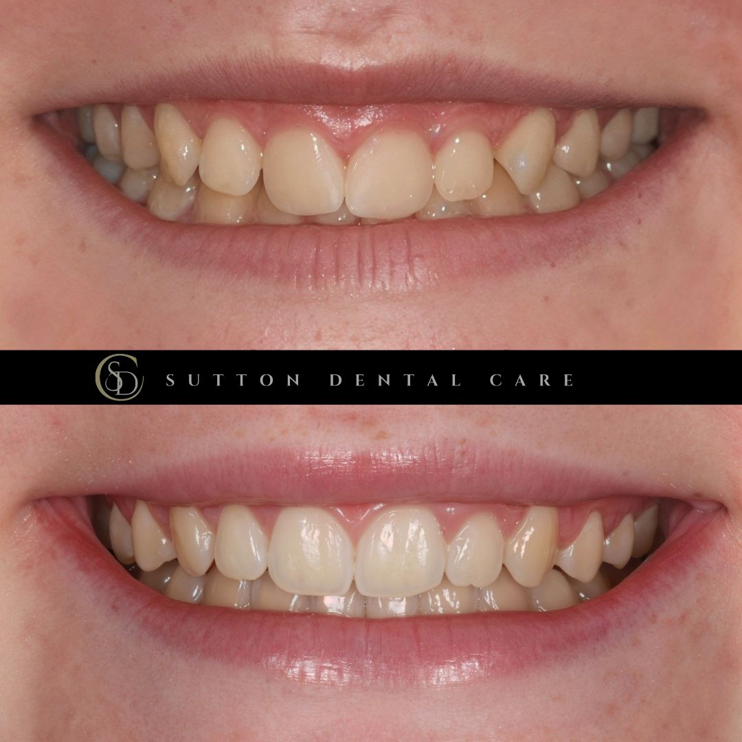 Fixed Braces - Before & After