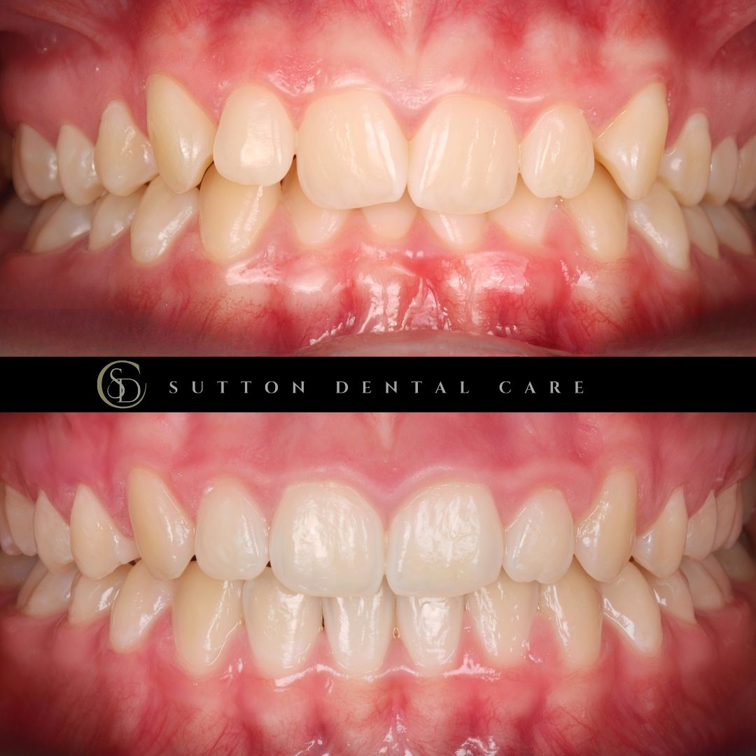 Fixed Braces - Before & After