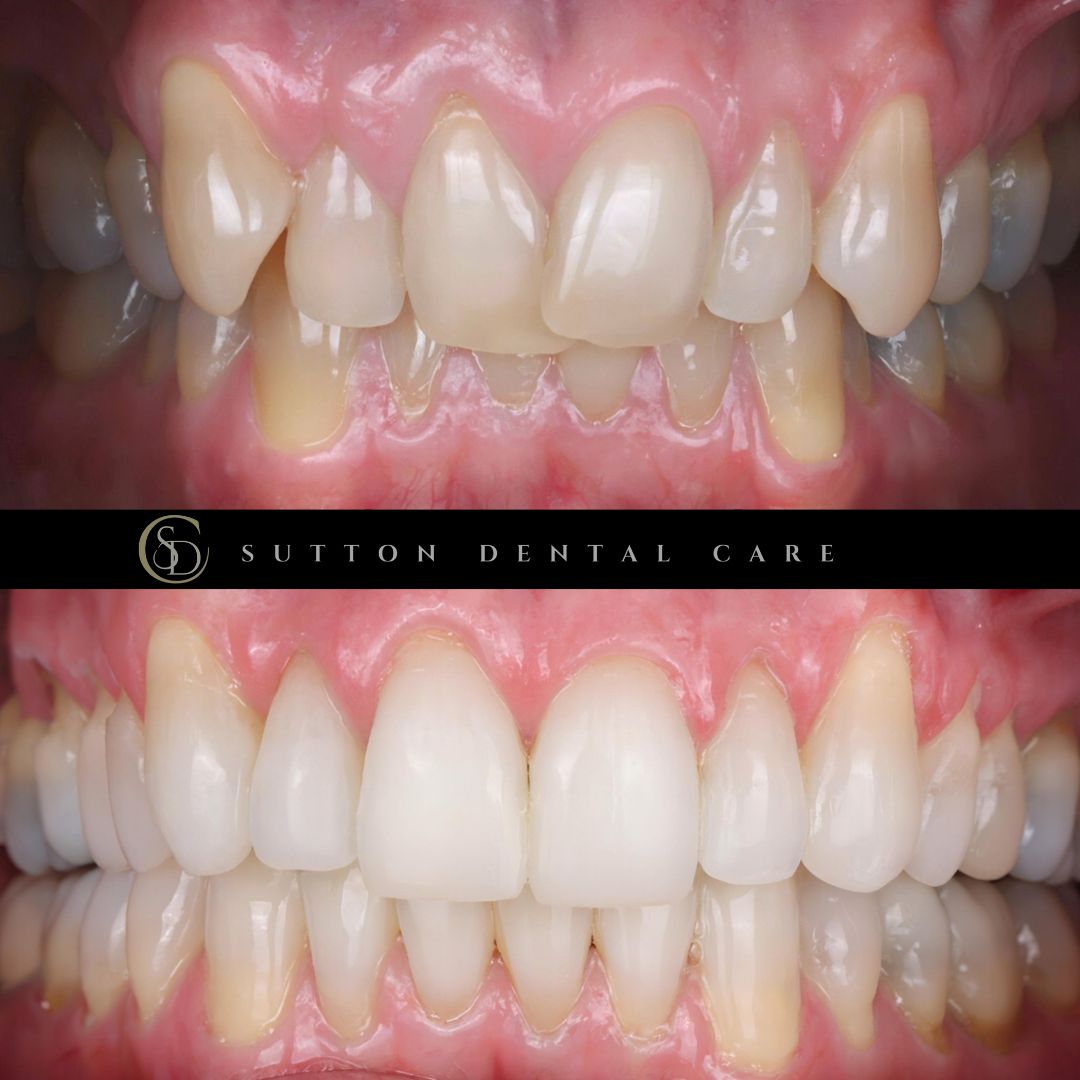 Clear Aligners, Whitening & Composite Bonding - Before & After