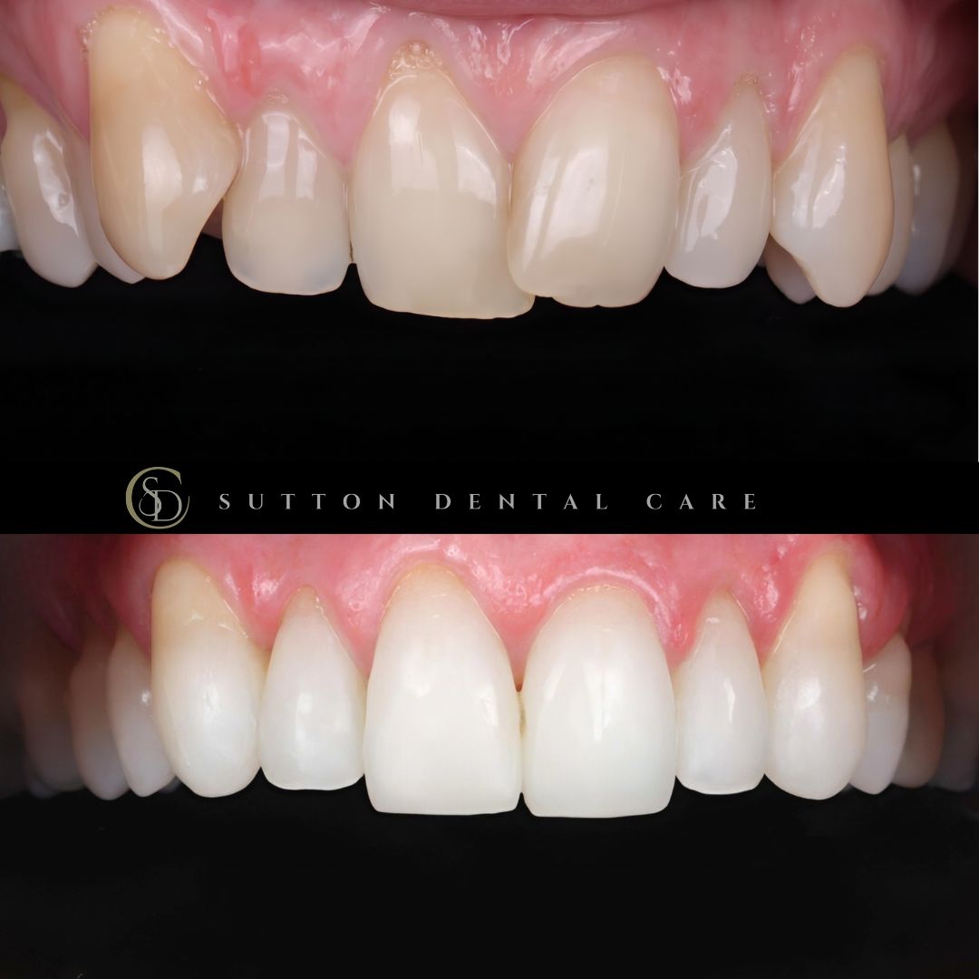 Clear Aligners, Whitening & Composite Bonding - Before & After