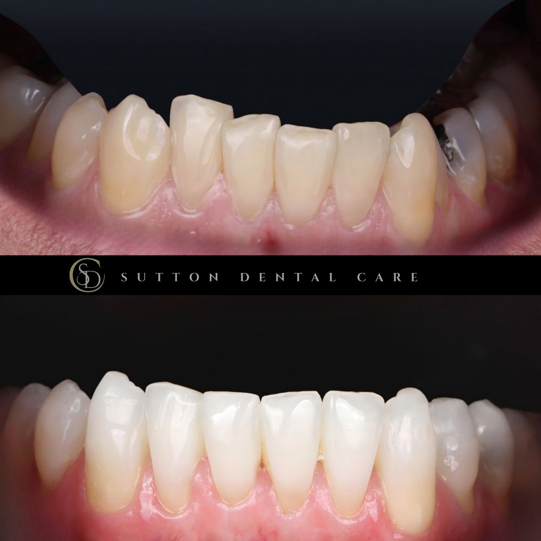 Clear Aligners, Whitening & Composite Bonding - Before & After