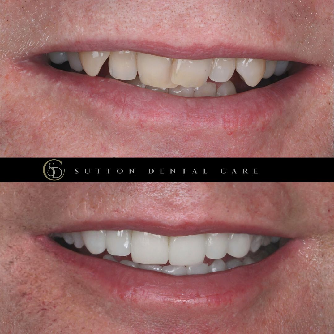 Clear Aligners, Whitening & Composite Bonding - Before & After