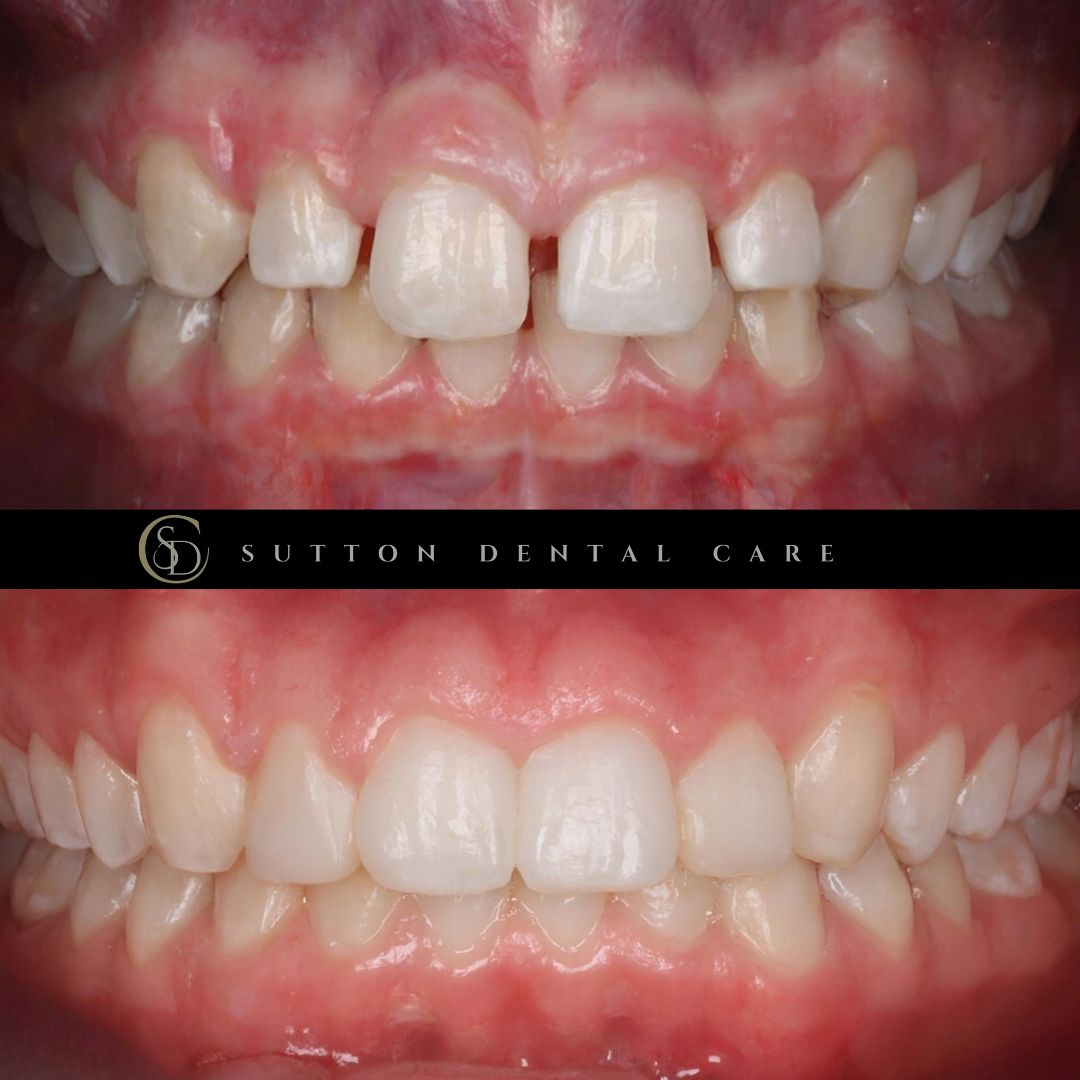 Fixed Braces & Composite Bonding - Before & After