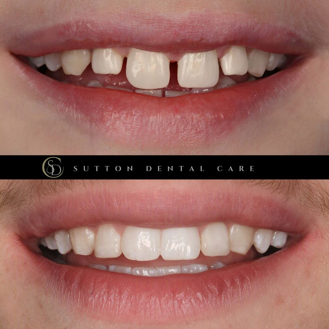 Fixed Braces & Composite Bonding - Before & After