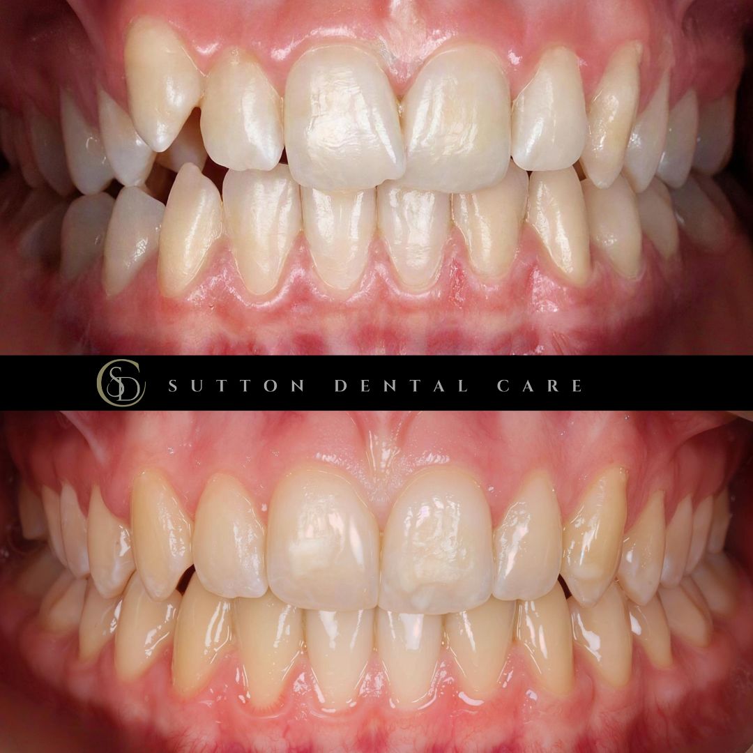 Fixed Braces - Before & After