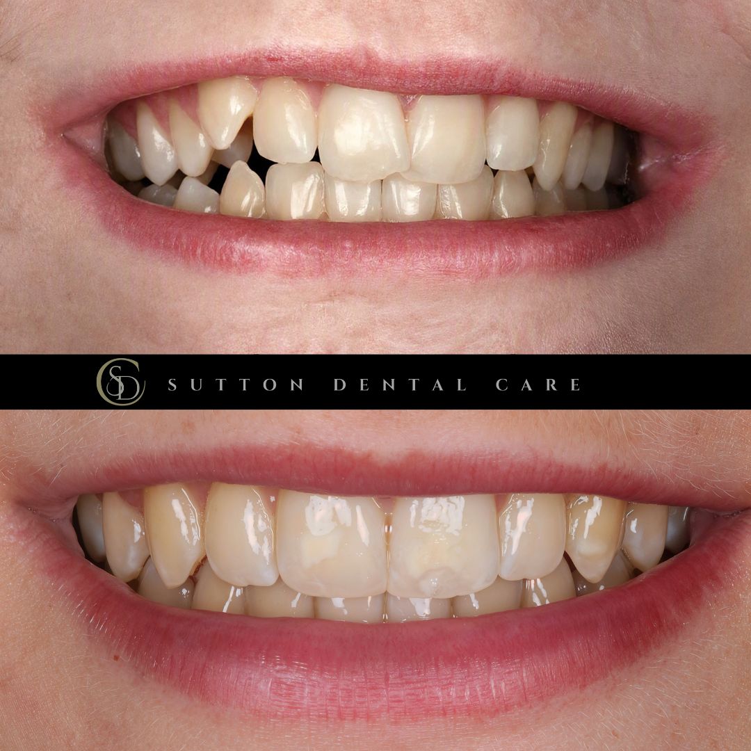 Fixed Braces - Before & After