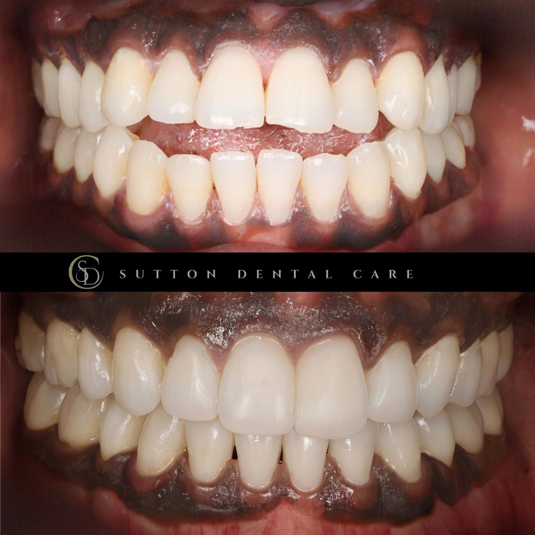 Fixed braces, Whitening & Composite Bonding - Before & After