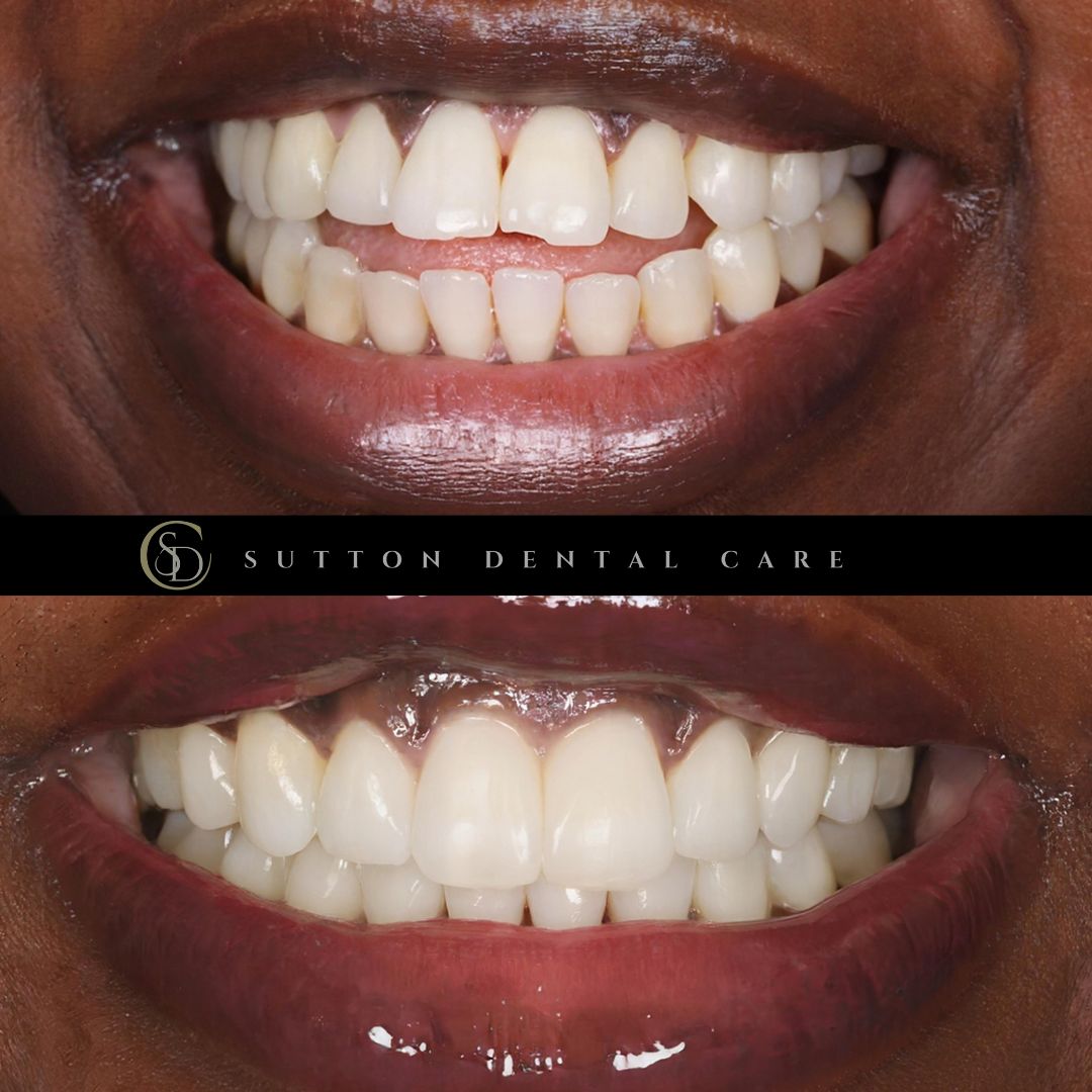 Fixed braces, Whitening & Composite Bonding - Before & After