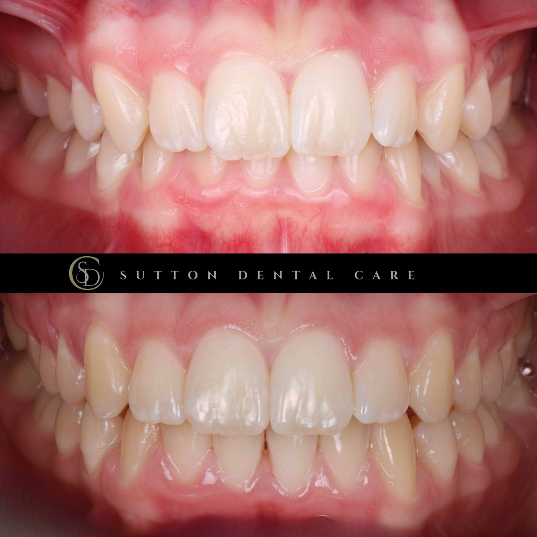 Fixed Braces - Before & After