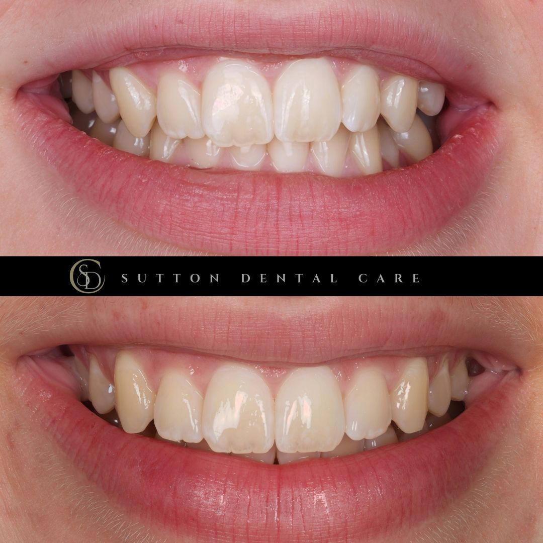 Fixed Braces - Before & After