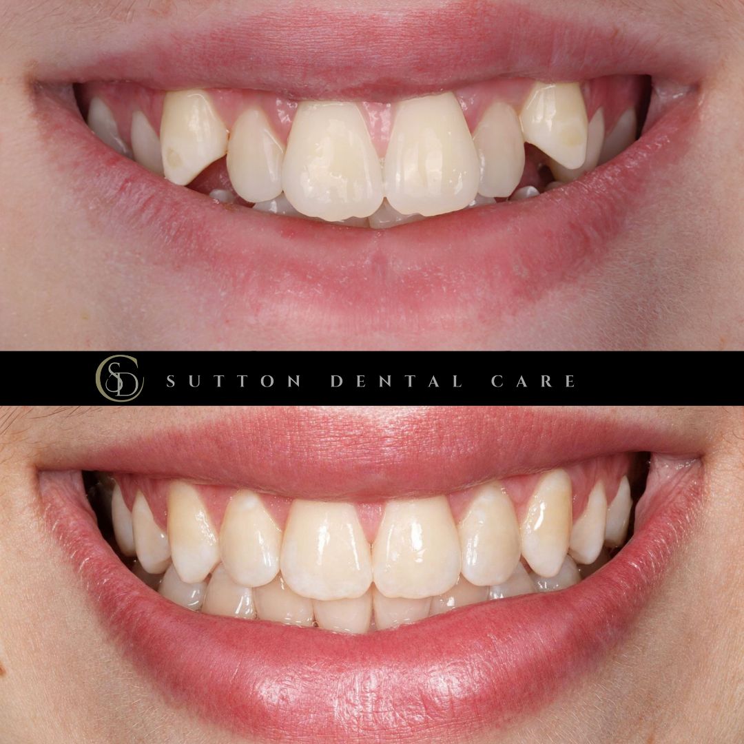 Fixed Braces - Before & After