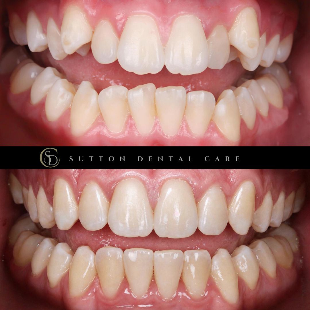 Fixed Braces - Before & After