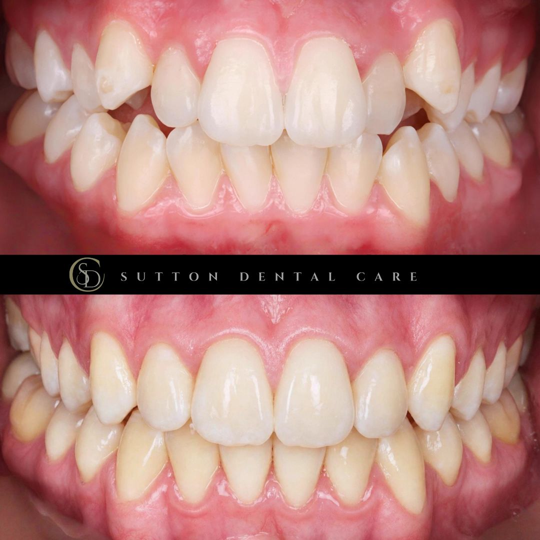 Fixed Braces - Before & After